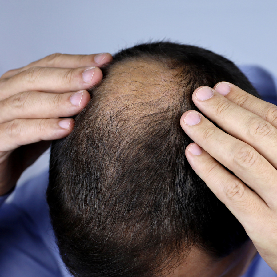 SR concern 3: thinning hair