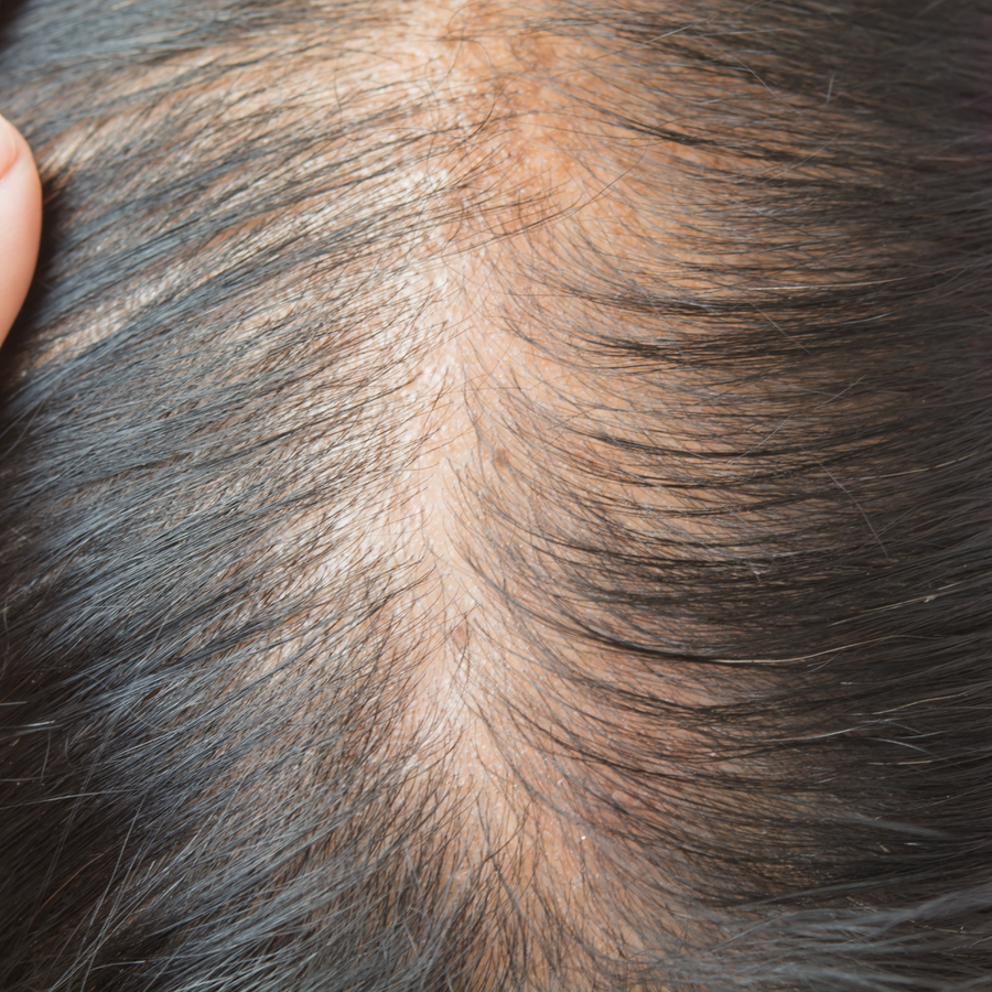 SR concern 2: thinning hair